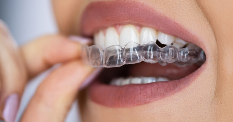 invisalign